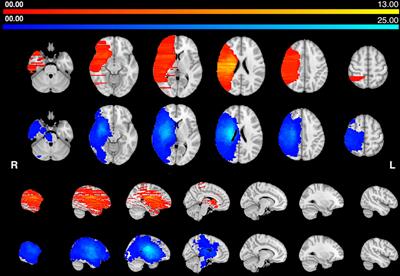Multiple Network Disconnection in Anosognosia for Hemiplegia